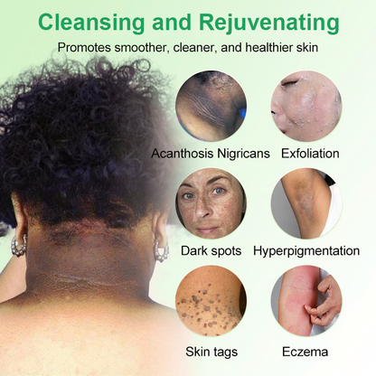 Purifying Exfoliating Gel for Acanthosis Nigricans, Exfoliation, Dark Spots, Skin Tags, and Eczema